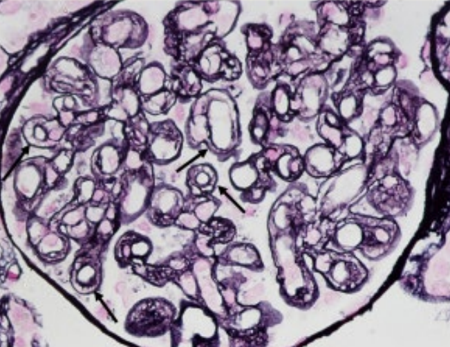 Renal Path Review Flashcards Memorang