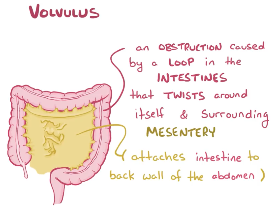 Volvulus Flashcards | Memorang