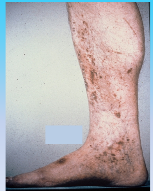 Dermatology Flashcards | Memorang