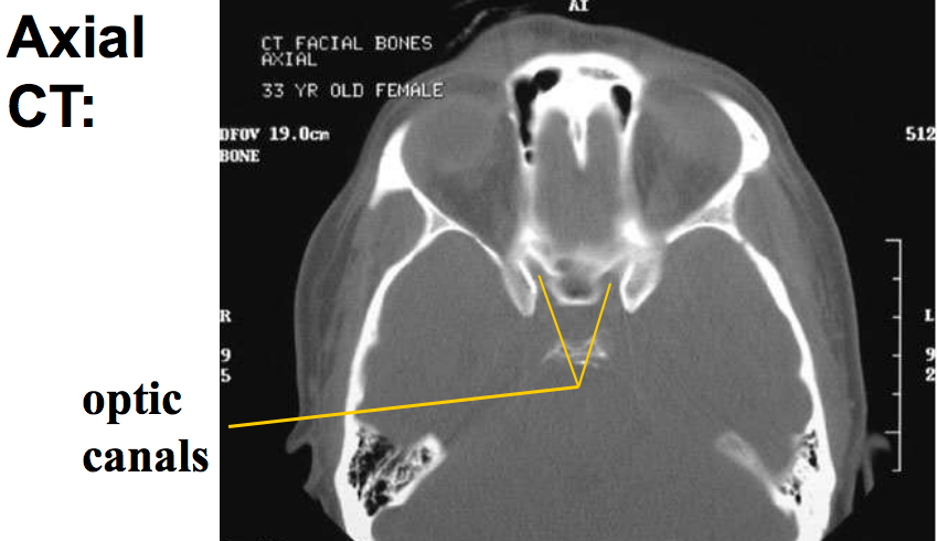Anterior Clinoid Process Radiology