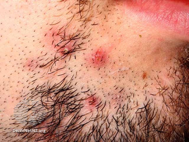 Common and Pigmented Skin Disorders Flashcards | Memorang