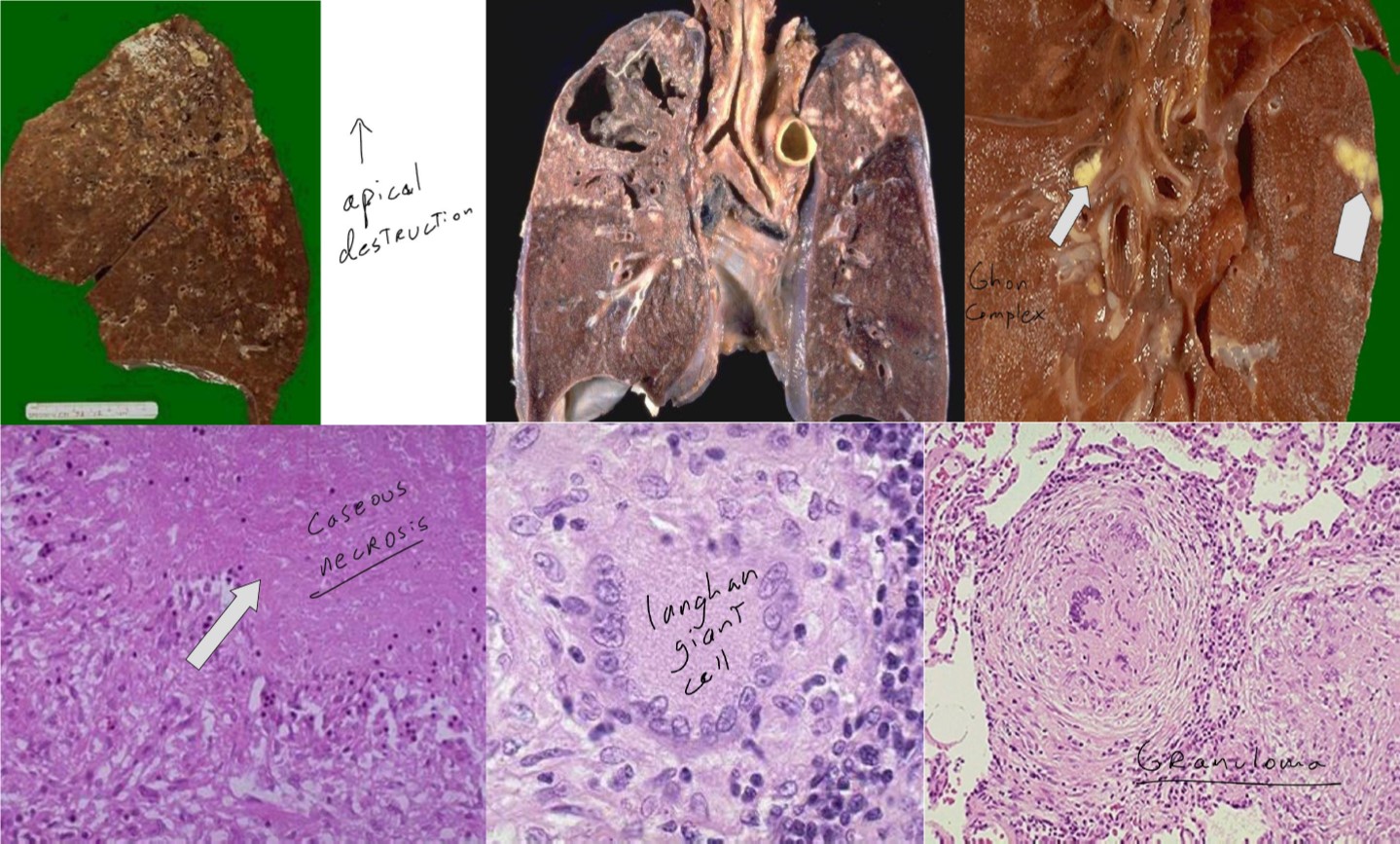 tuberculosis lungs histology