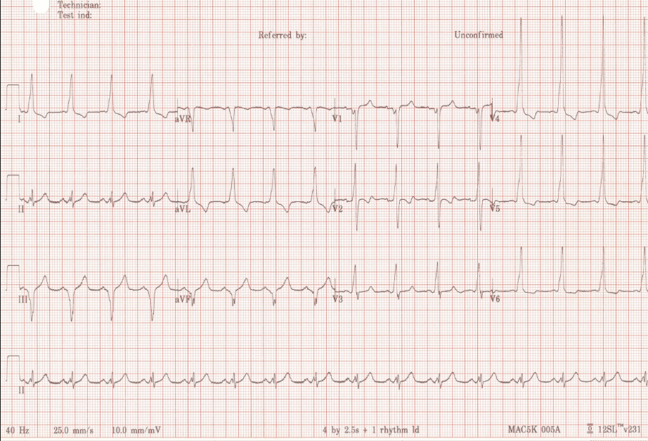 ECGs Flashcards | Memorang