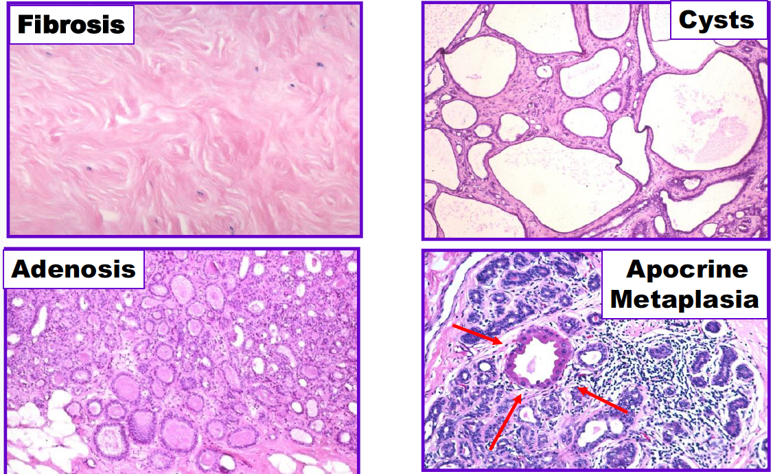 Apocrine Metaplasia