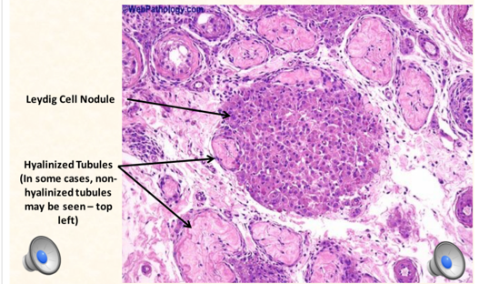 Testicular Atrophy Histology Labelled