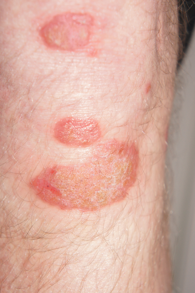 Common and Pigmented Skin Disorders Flashcards | Memorang