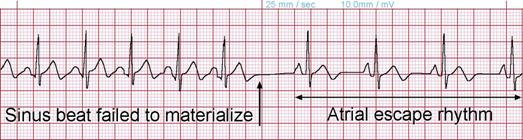 ECGs Flashcards | Memorang