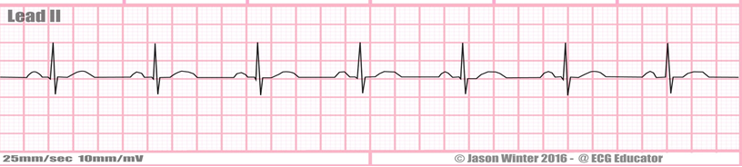 ECGs Flashcards | Memorang