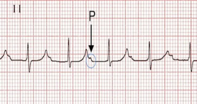 EKG Flashcards | Memorang