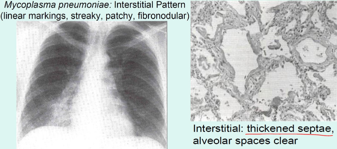 Atypical Pneumonia X Ray Pattern