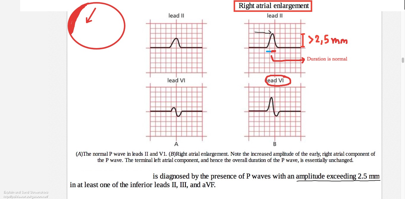 EKG Flashcards Memorang