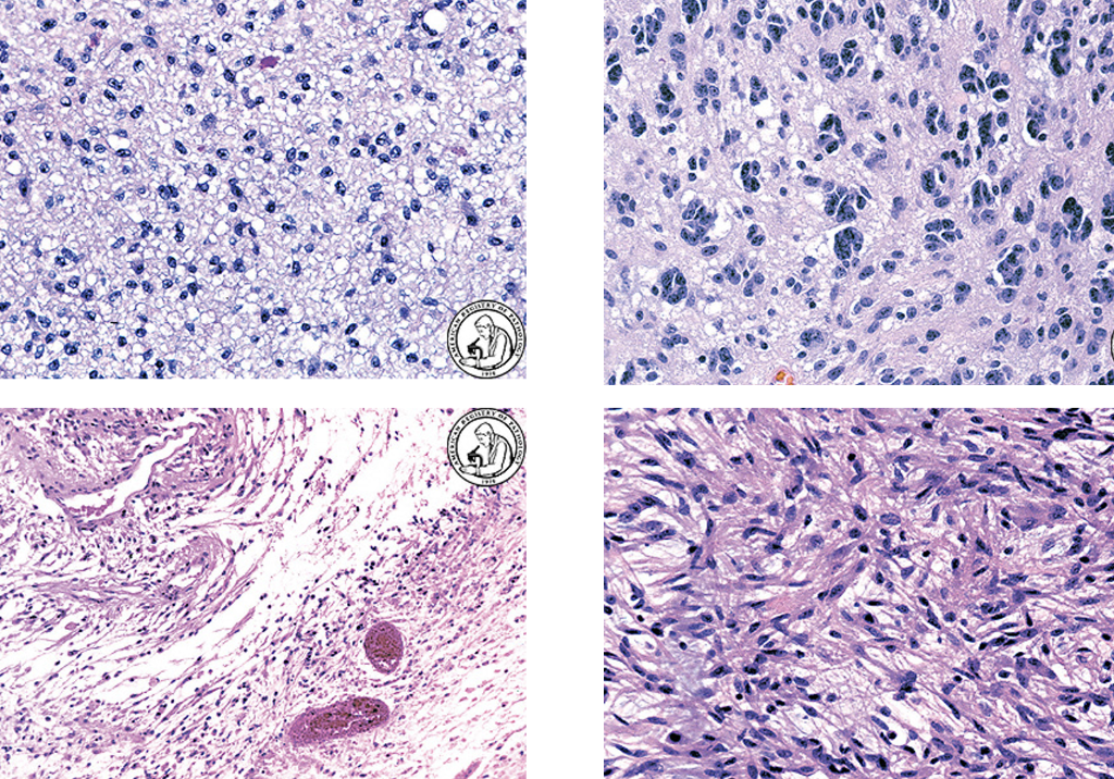 7-benign-or-low-grade-tumors-often-mistaken-for-worse-lesion-flashcards