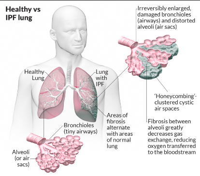 Pulmonary Flashcards | Memorang