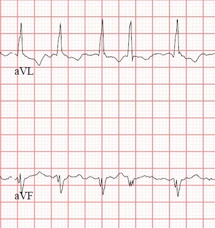 Arrhythmia Flashcards | Memorang