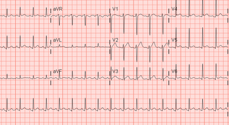 EKG Flashcards | Memorang