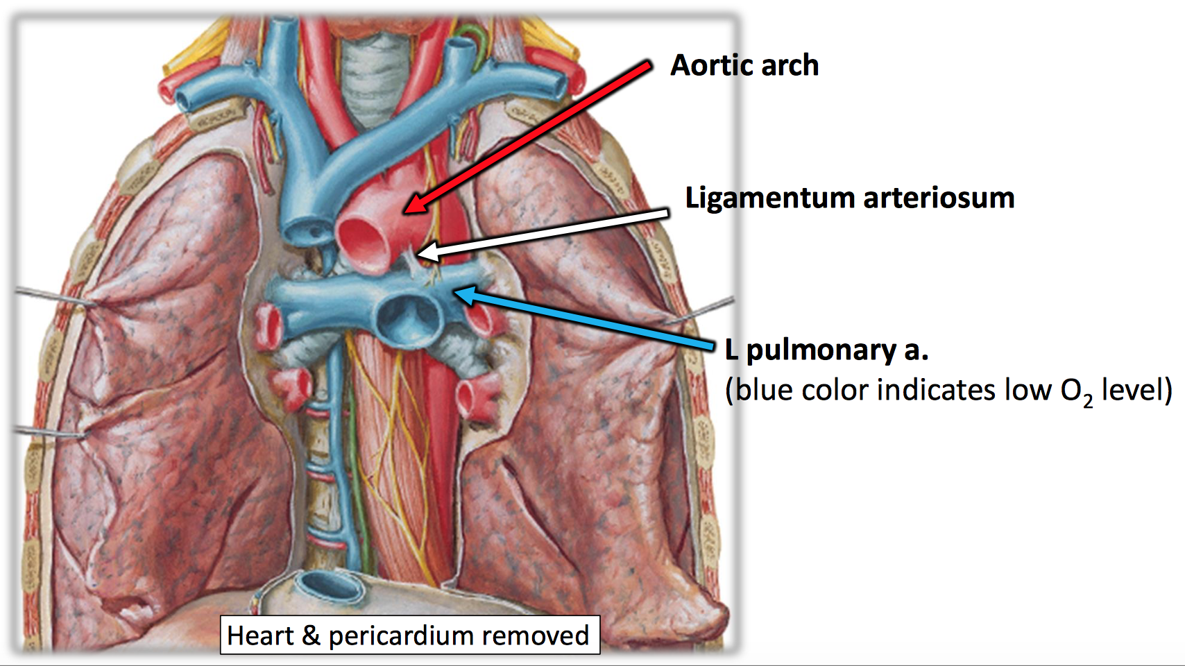 Ligamentum Arteriosum