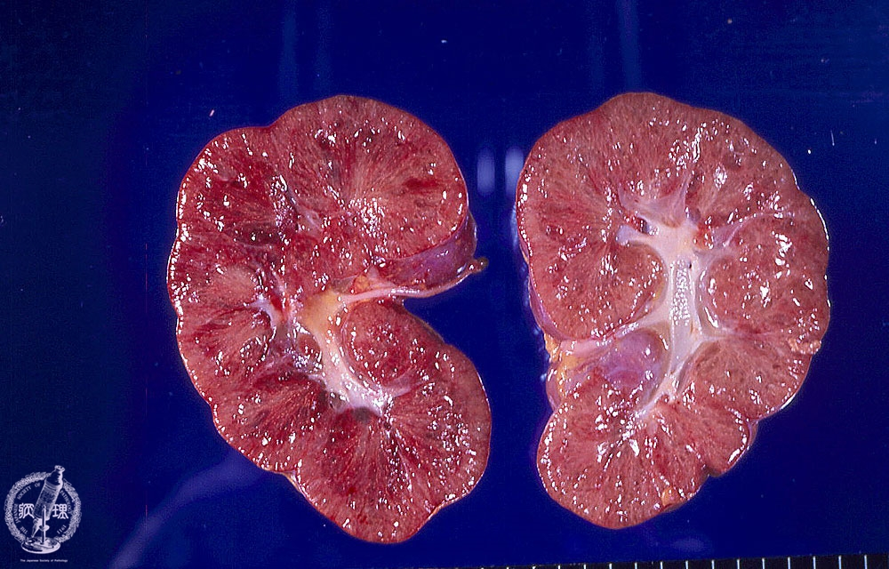 Renal | Pathology Images Flashcards | Memorang