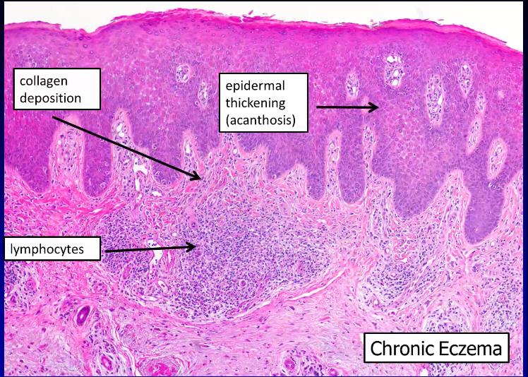 Dermatopathology Flashcards | Memorang