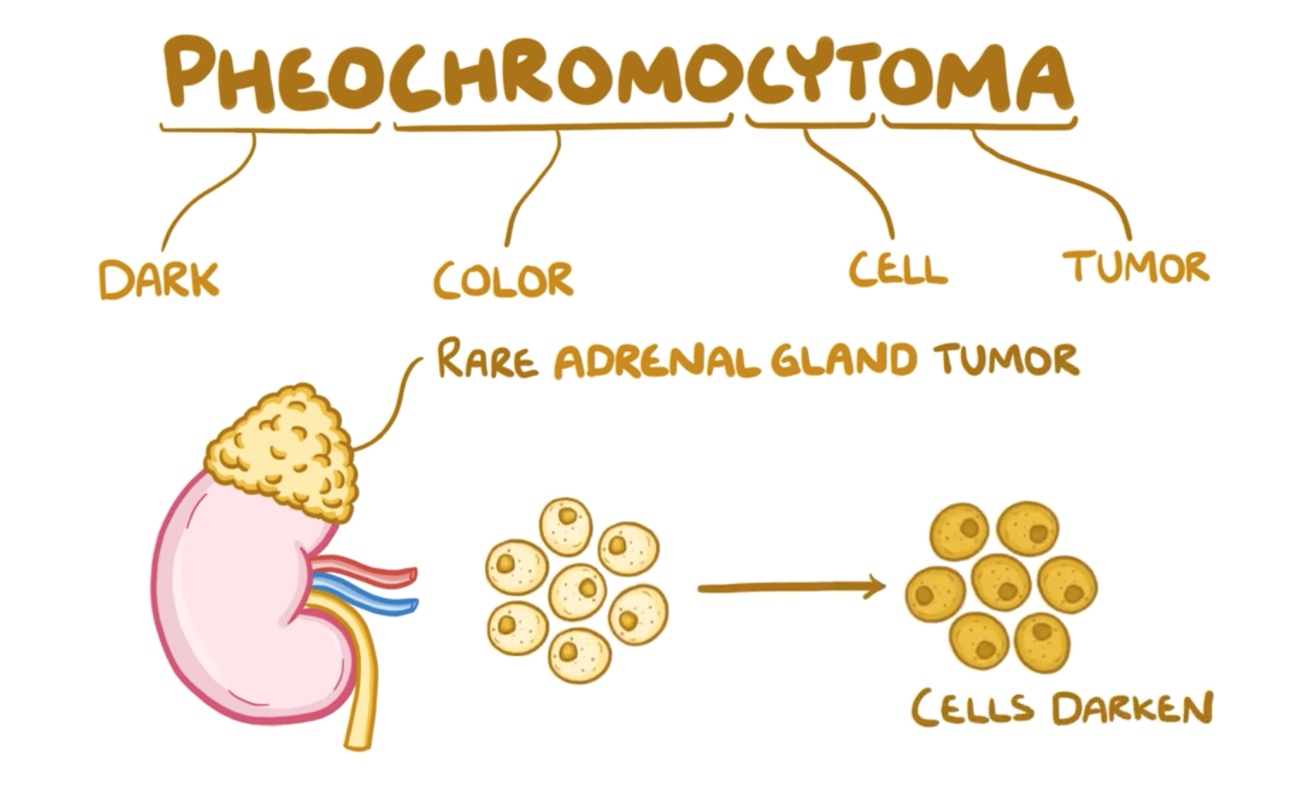 pheochromocytoma-flashcards-memorang