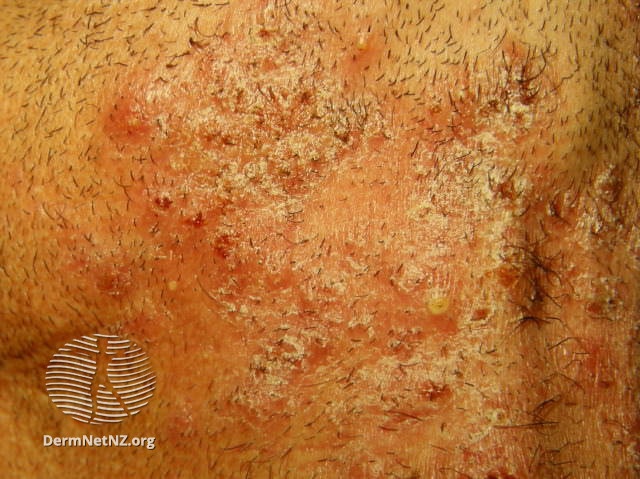 Common and Pigmented Skin Disorders Flashcards | Memorang