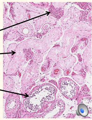 Testicular Atrophy Histology Labelled