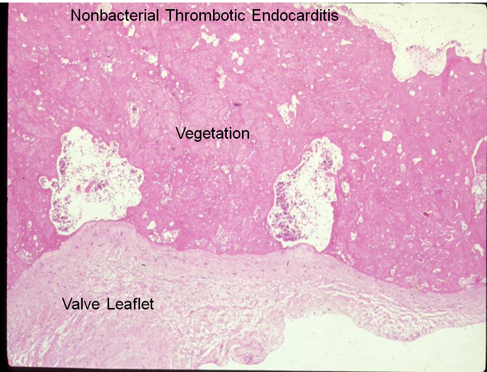 infective endocarditis histology