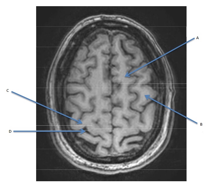 Neuroimaging Flashcards | Memorang