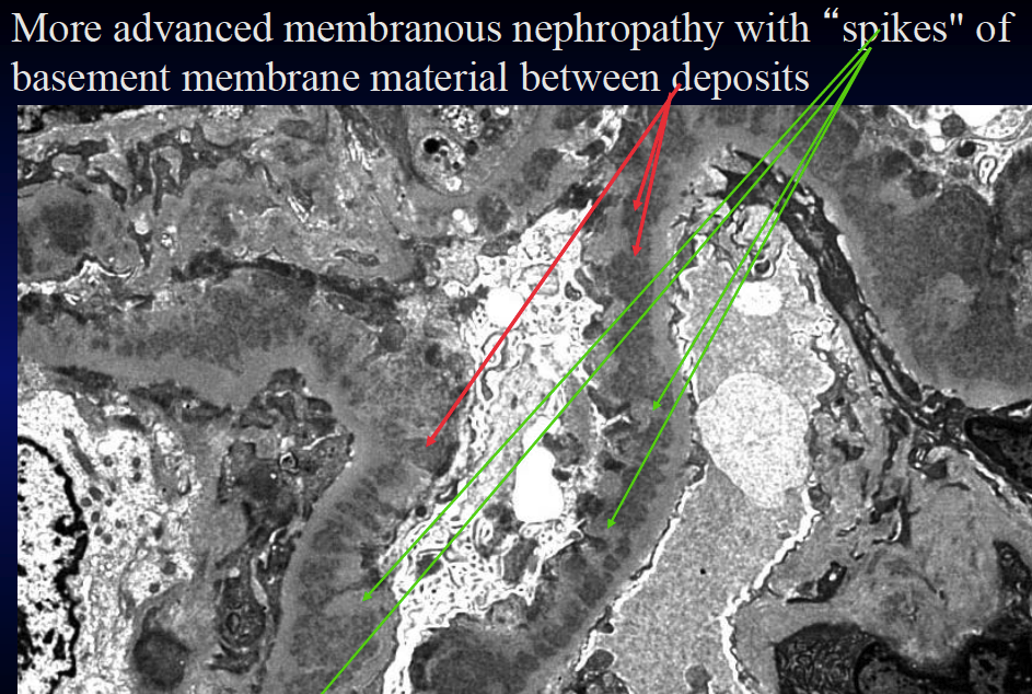Membranous Nephropathy Spike And Dome