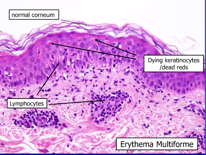 Dermatopathology Flashcards | Memorang