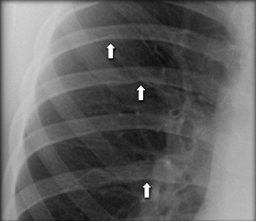 Thorax and Spine Flashcards | Memorang