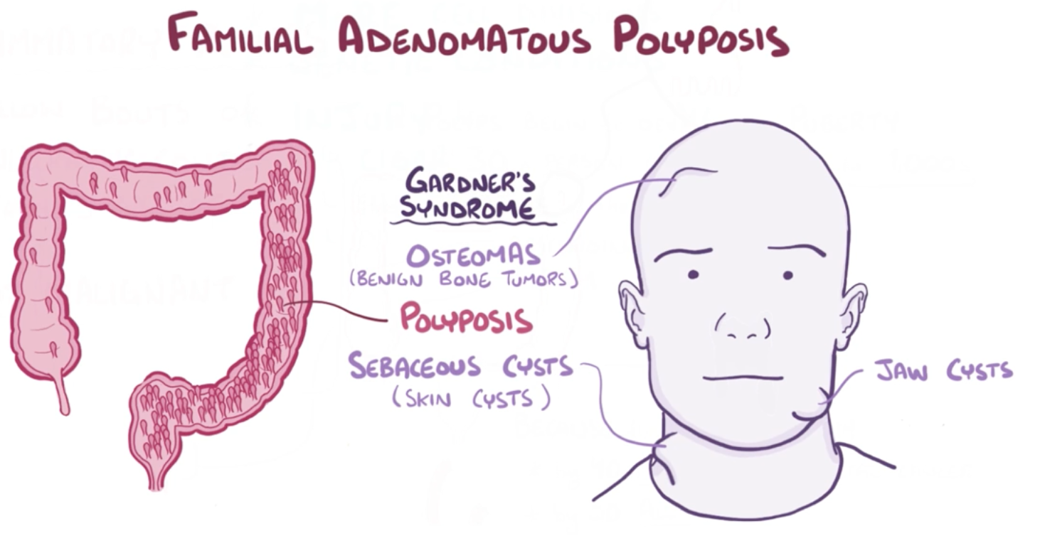 Familial Adenomatous Polyposis Drawing