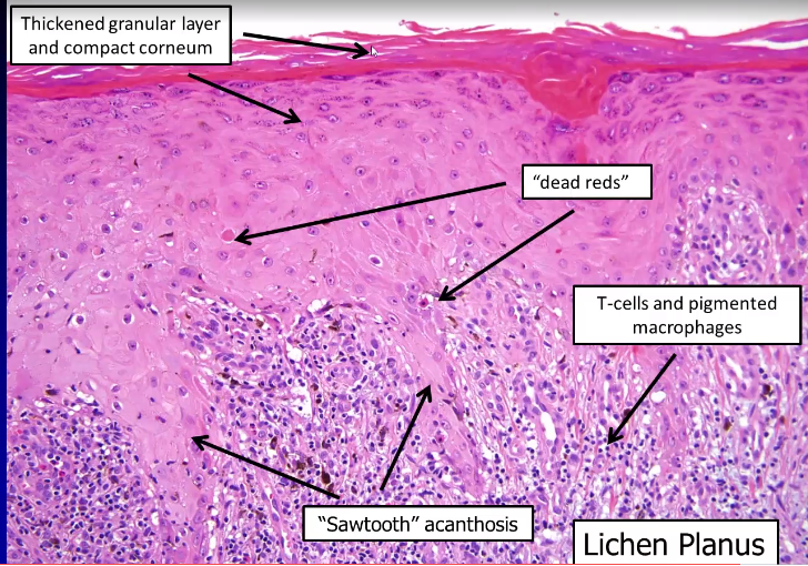 Dermatopathology Flashcards | Memorang