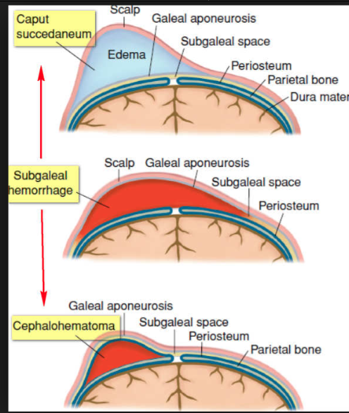 Subaponeurotic hemorrhage