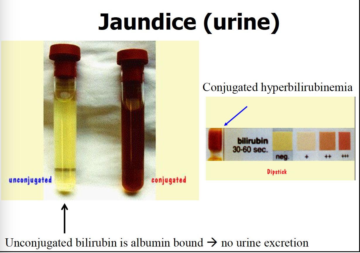 Bilirubin In Urine Color