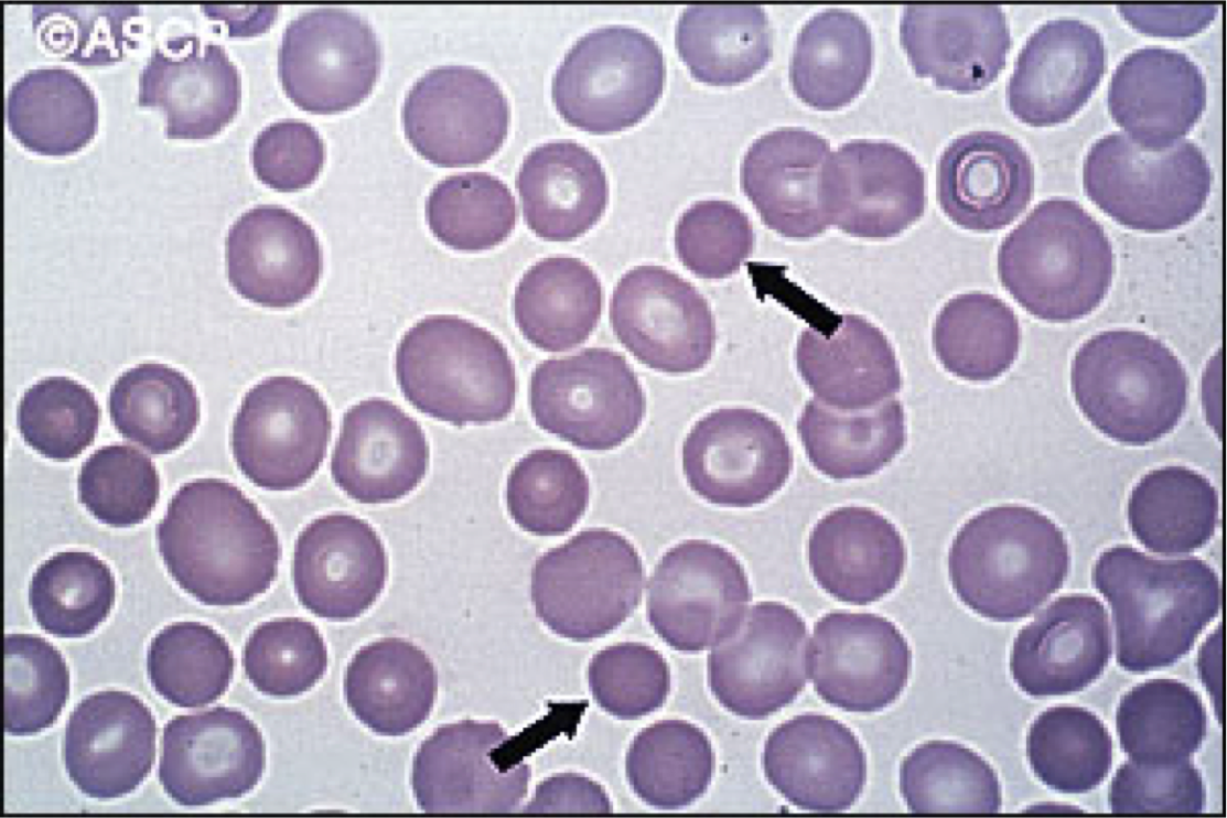 Hematology Flashcards Memorang
