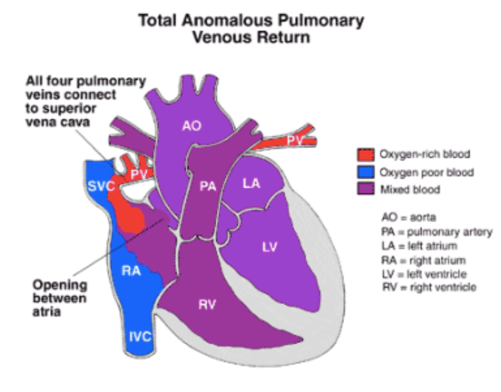 Congenital Heart Disease Flashcards | Memorang