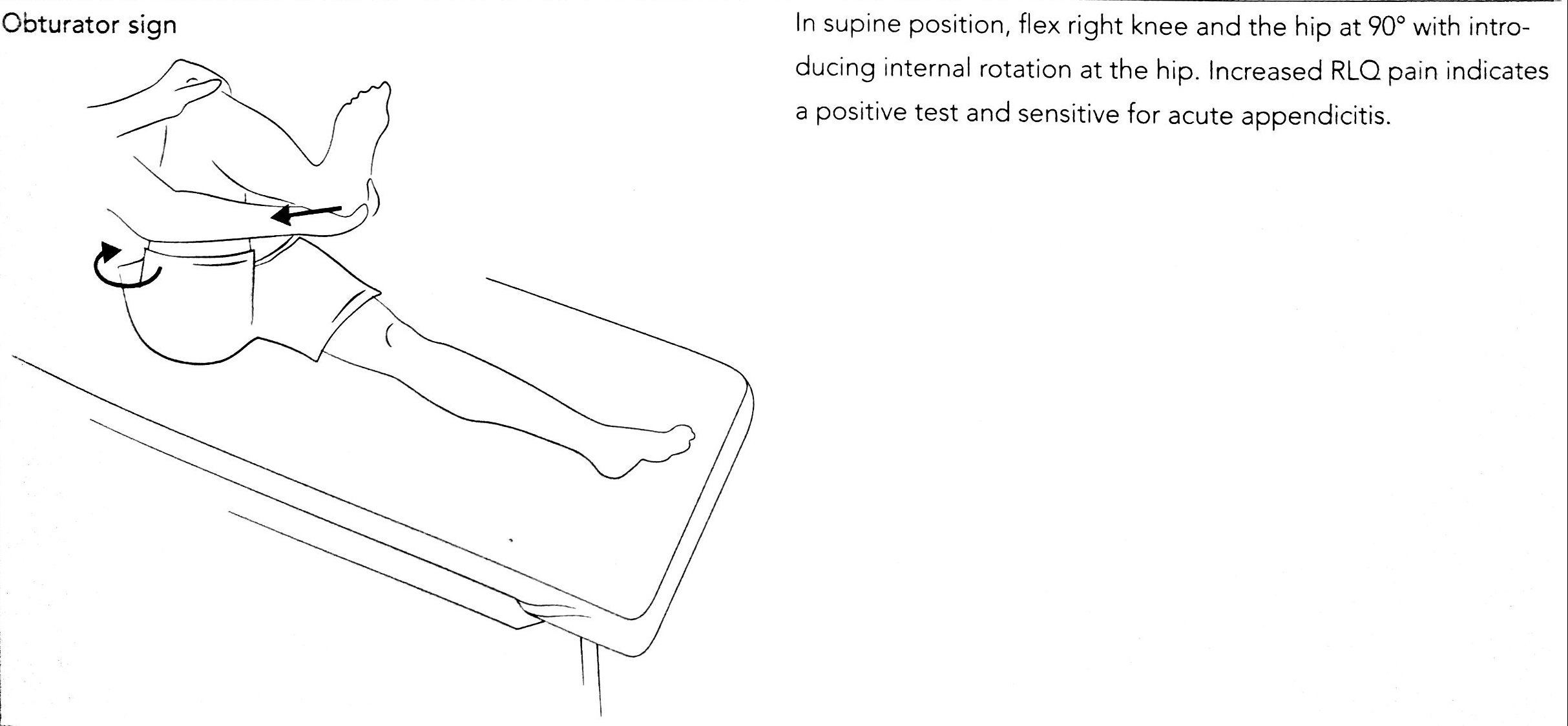 Testing Obturator Sign Obturator Sign Test