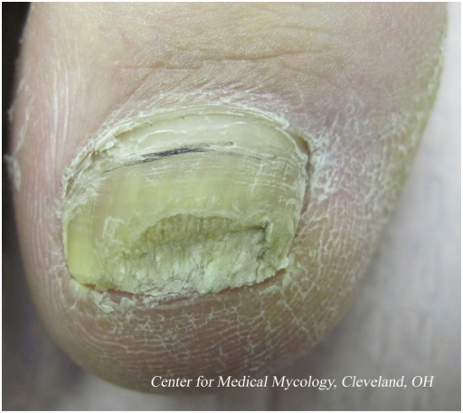 Cutaneous Mycoses Flashcards | Memorang