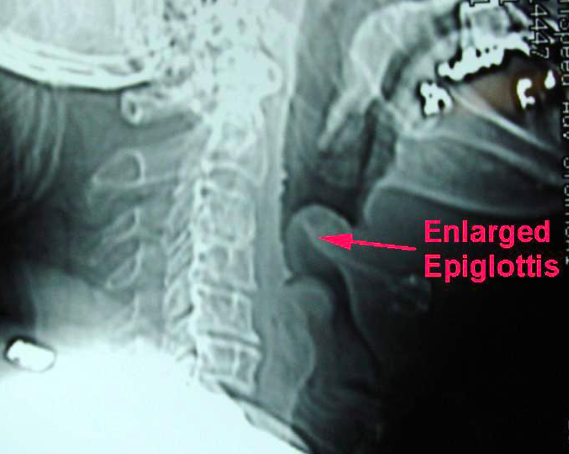 Thumbprint Sign Epiglottitis Bacteria