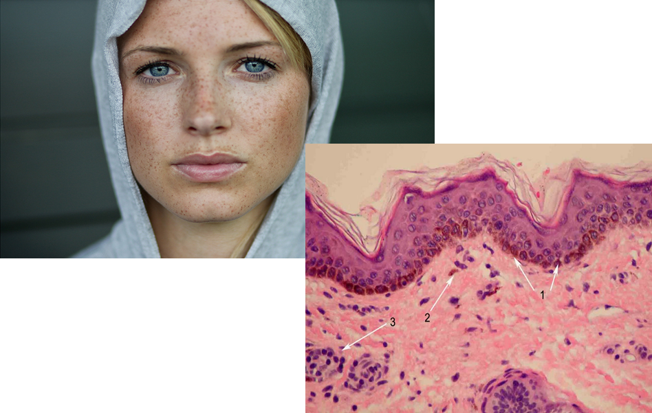 melenic vs melanotic ORAL MELANOTIC MACULE (OMM) (Also called focal melanosis / labial melanotic  macule) → A benign, localized, flat pigmented lesion of the oral mucosa →  Caused by a focal increase in melanin production