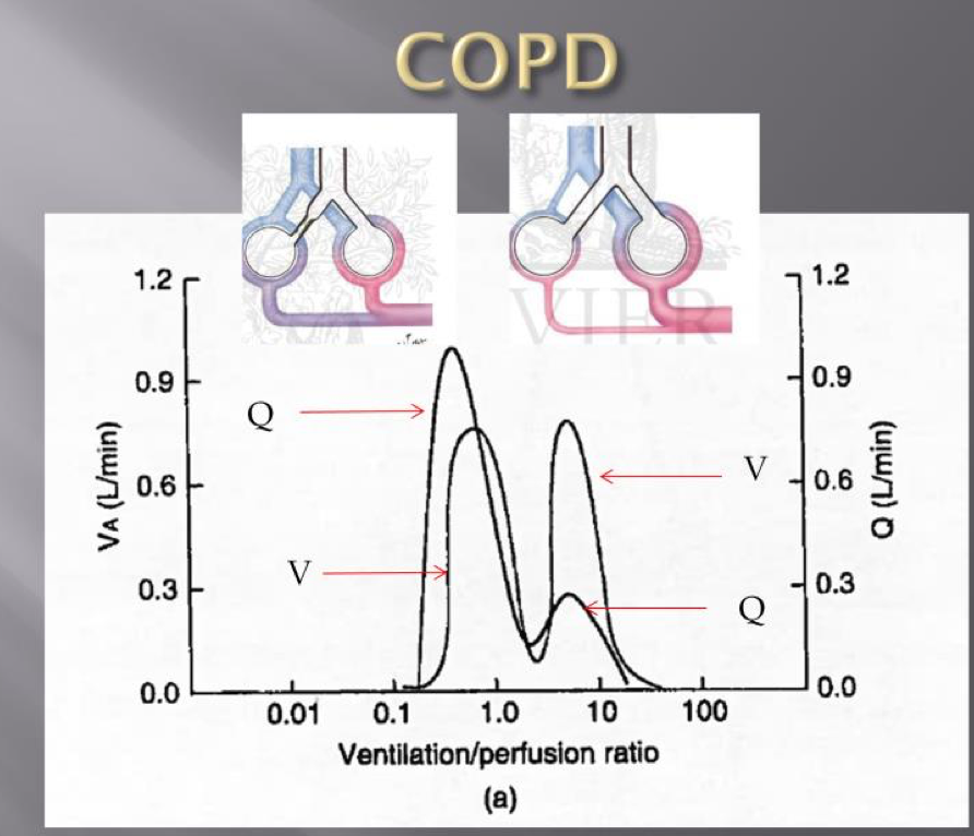 Why Does Oxygen Therapy Cause Hypercapnia In Copd Rk vrogue.co