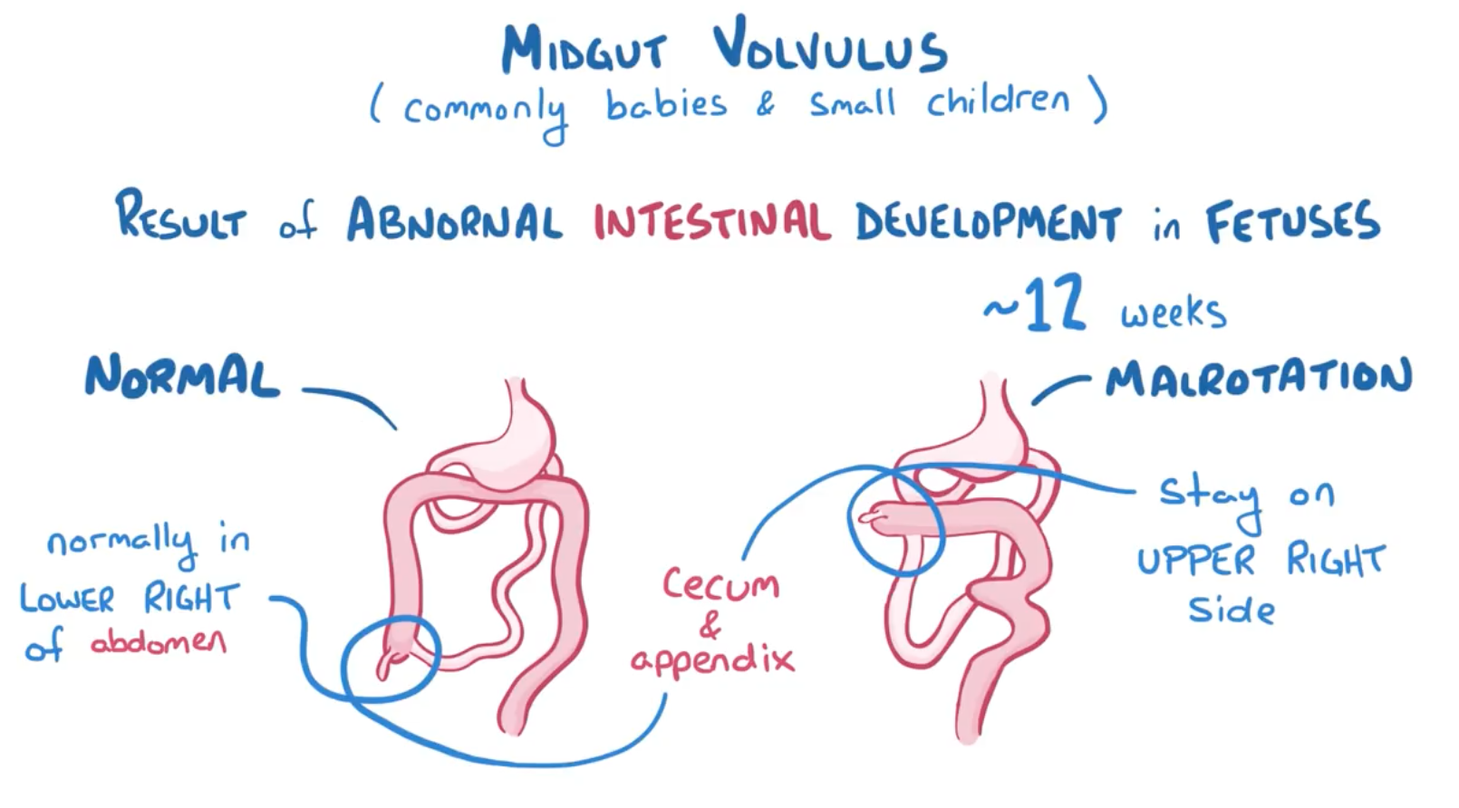 Volvulus Flashcards | Memorang