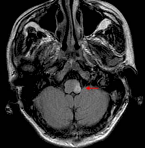 Stroke Syndromes Flashcards | Memorang