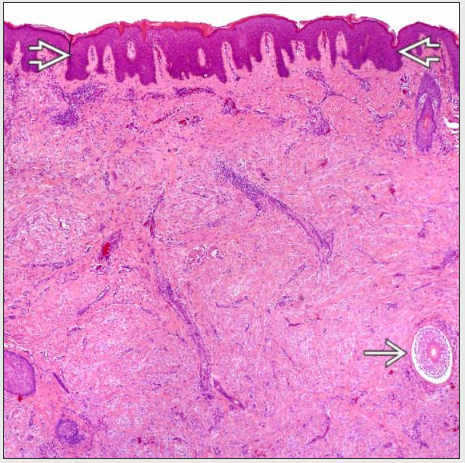 Dermatomyofibroma Flashcards | Memorang