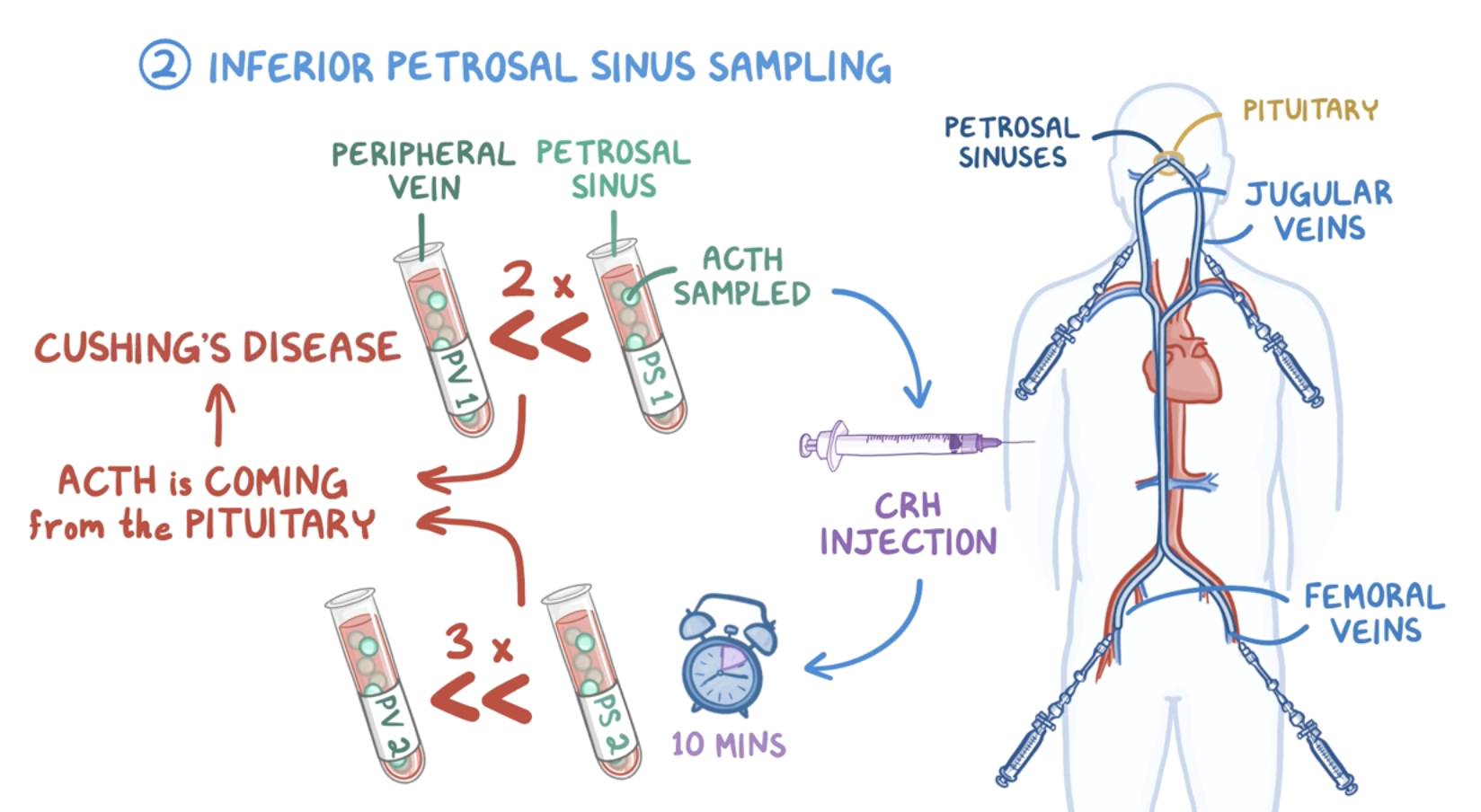inferior petrosal sinus sampling